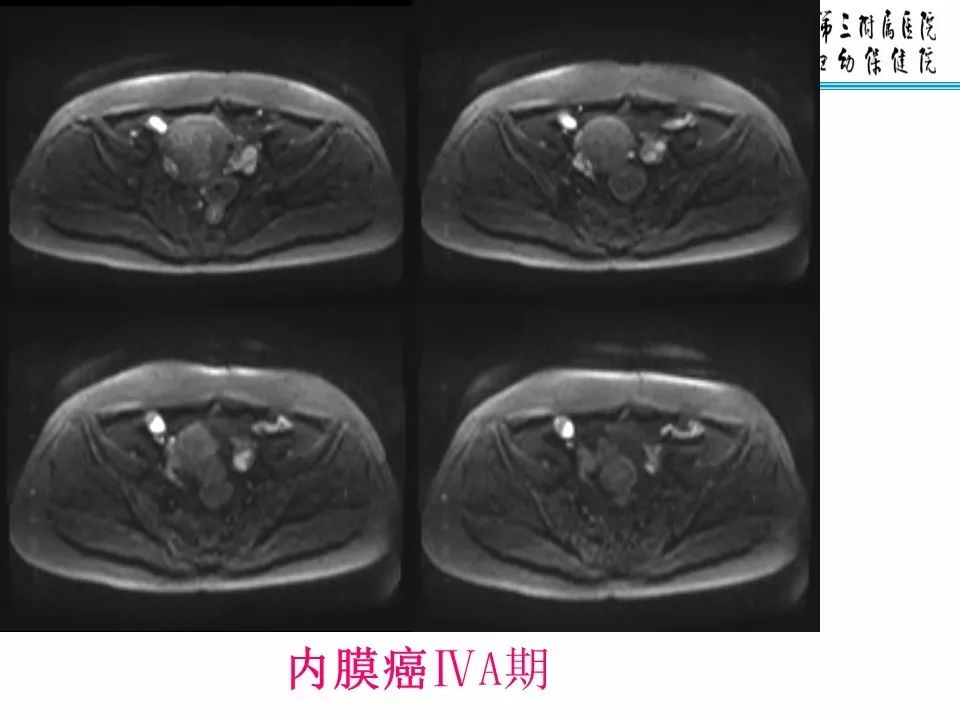 【PPT】子宫常见肿瘤的MRI表现