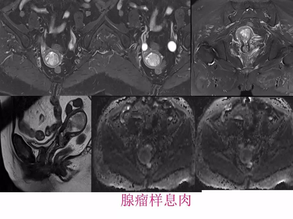 【PPT】子宫常见肿瘤的MRI表现