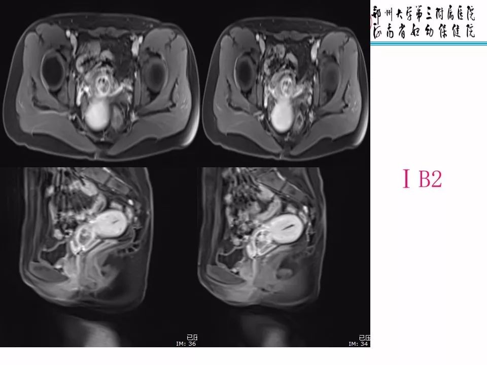 【PPT】子宫常见肿瘤的MRI表现