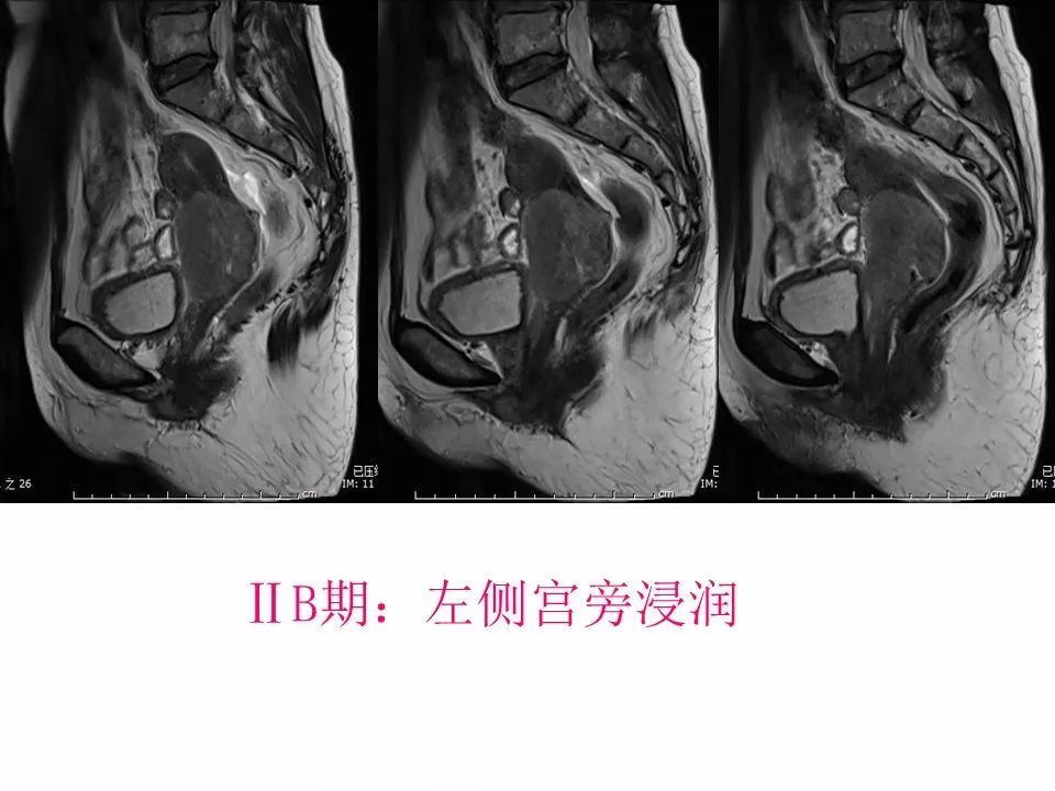 【PPT】子宫常见肿瘤的MRI表现