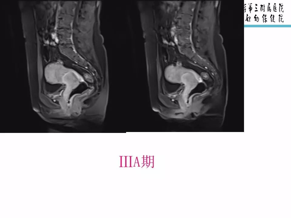 【PPT】子宫常见肿瘤的MRI表现