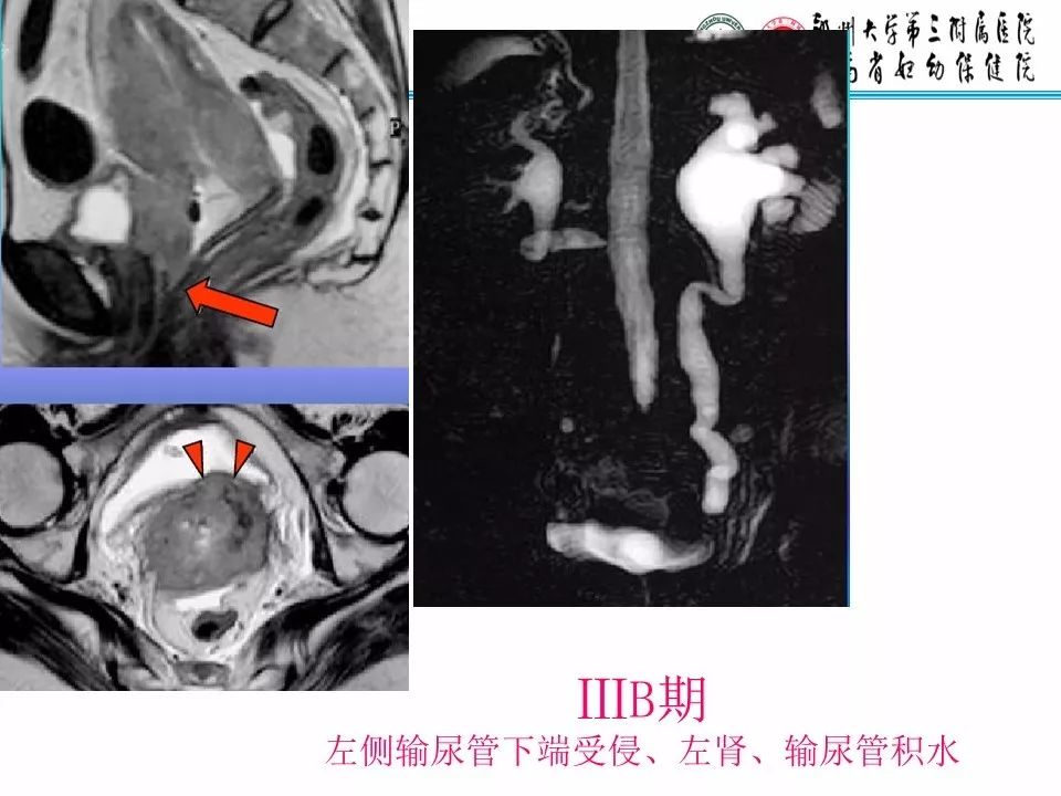【PPT】子宫常见肿瘤的MRI表现
