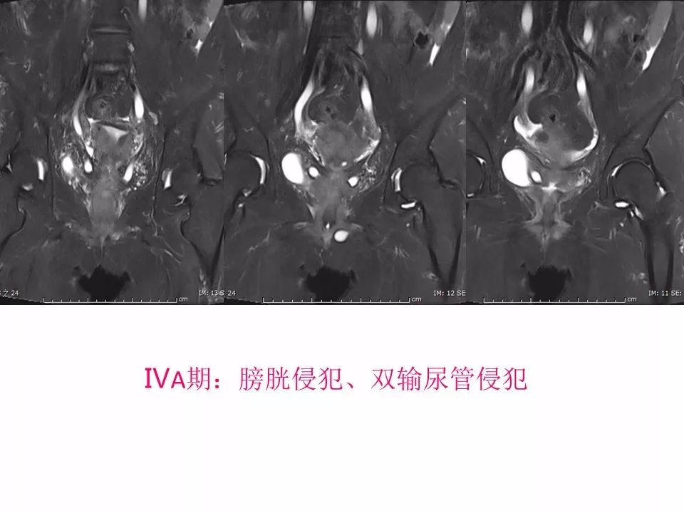 【PPT】子宫常见肿瘤的MRI表现