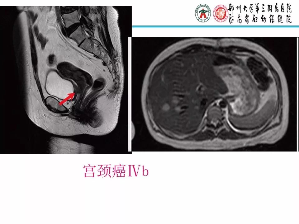 【PPT】子宫常见肿瘤的MRI表现