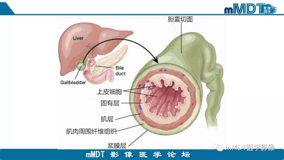 【PPT】黄色肉芽肿性胆囊炎与厚壁型胆囊癌的影像表现及鉴别要点