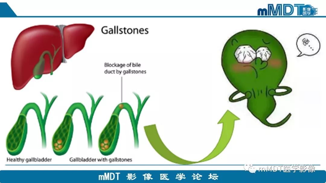 【PPT】黄色肉芽肿性胆囊炎与厚壁型胆囊癌的影像表现及鉴别要点