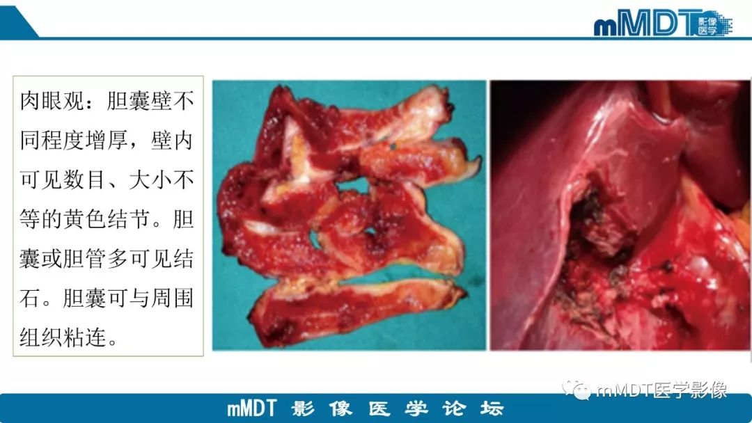 【PPT】黄色肉芽肿性胆囊炎与厚壁型胆囊癌的影像表现及鉴别要点