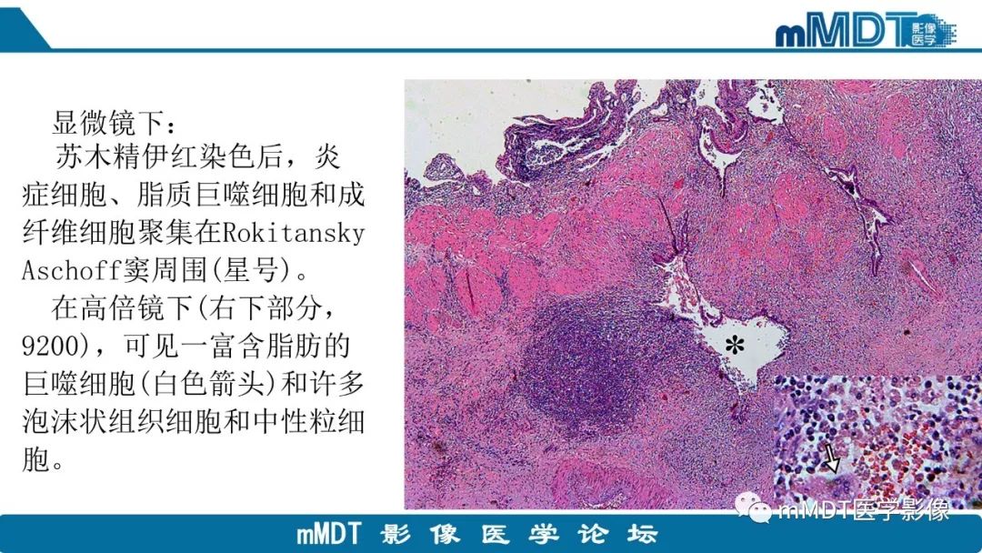 【PPT】黄色肉芽肿性胆囊炎与厚壁型胆囊癌的影像表现及鉴别要点