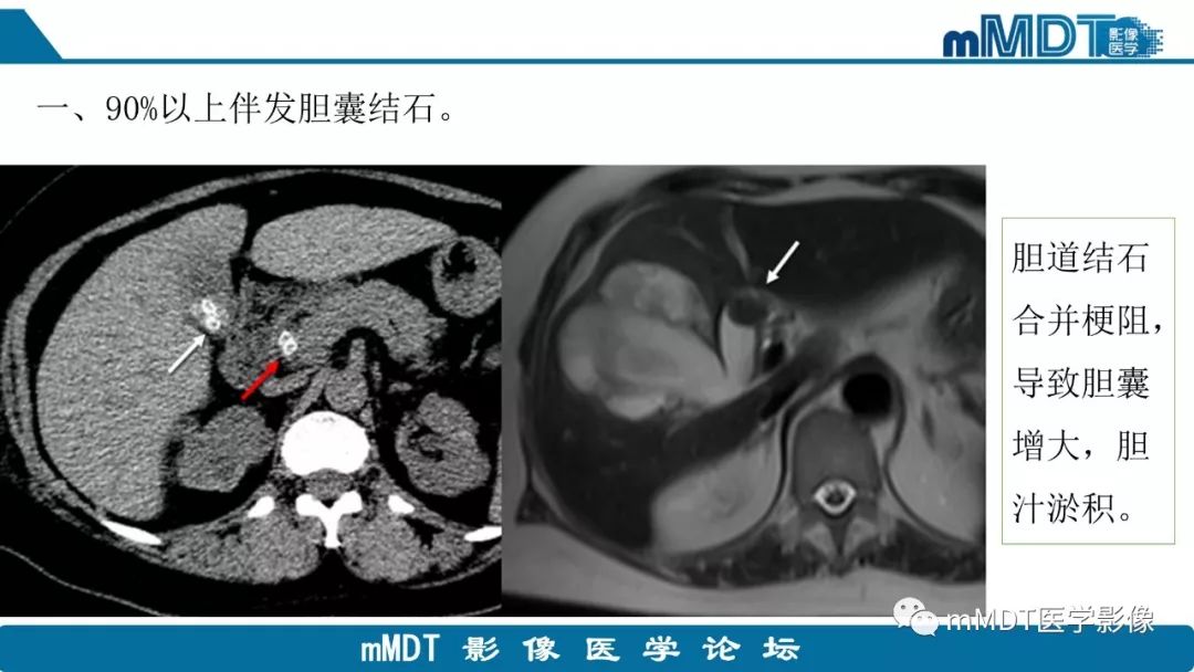 【PPT】黄色肉芽肿性胆囊炎与厚壁型胆囊癌的影像表现及鉴别要点
