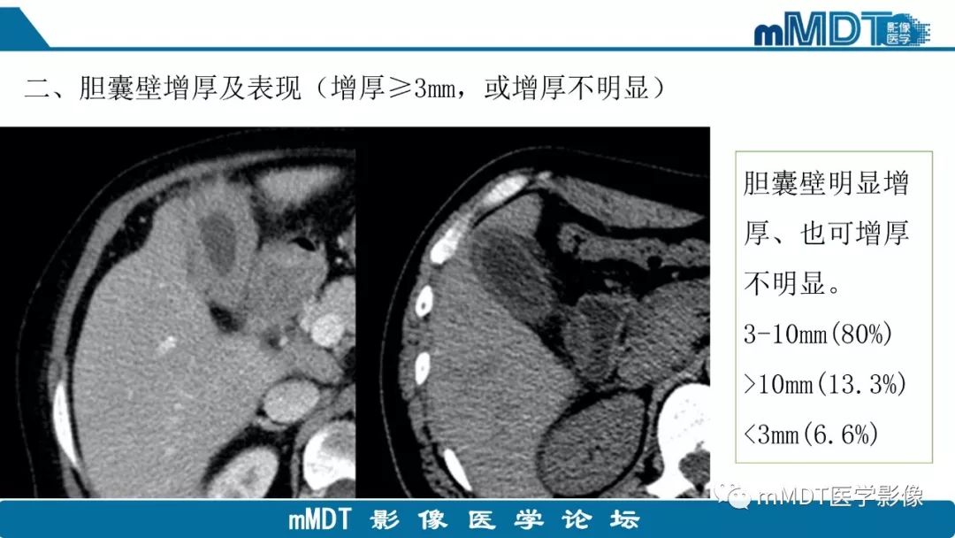 【PPT】黄色肉芽肿性胆囊炎与厚壁型胆囊癌的影像表现及鉴别要点