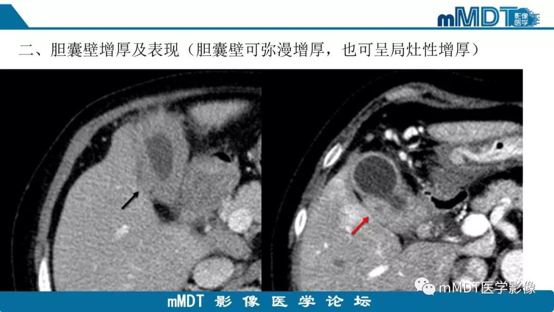 【PPT】黄色肉芽肿性胆囊炎与厚壁型胆囊癌的影像表现及鉴别要点