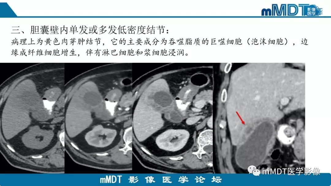 【PPT】黄色肉芽肿性胆囊炎与厚壁型胆囊癌的影像表现及鉴别要点