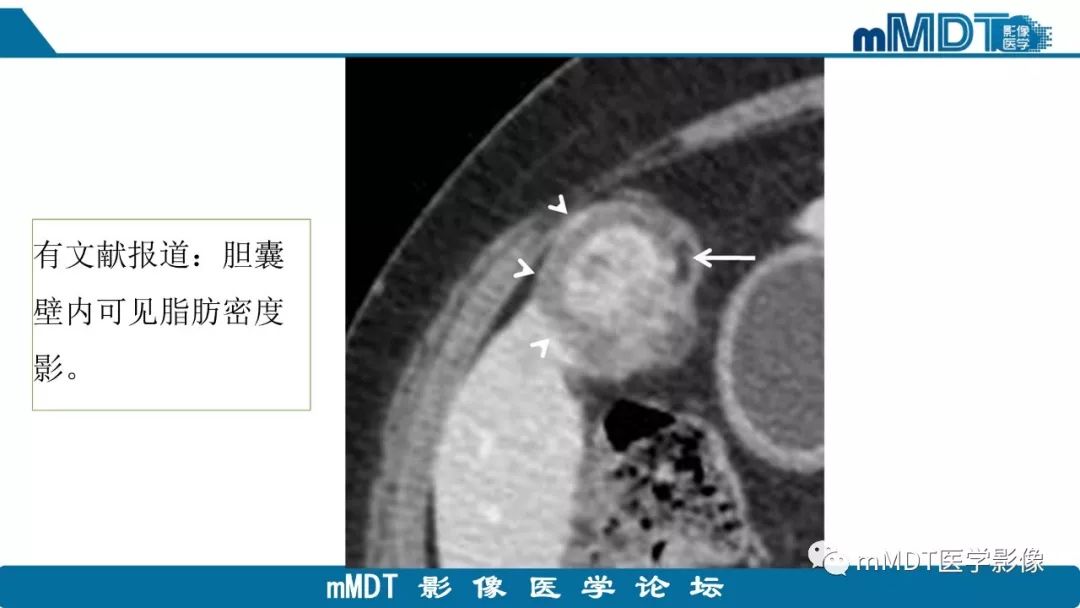 【PPT】黄色肉芽肿性胆囊炎与厚壁型胆囊癌的影像表现及鉴别要点