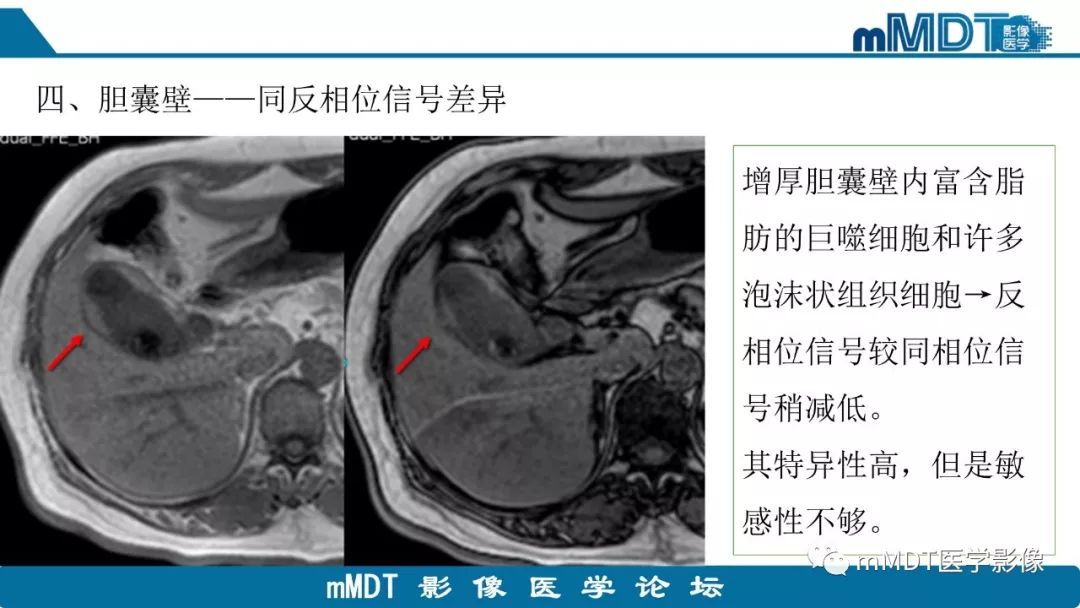 【PPT】黄色肉芽肿性胆囊炎与厚壁型胆囊癌的影像表现及鉴别要点
