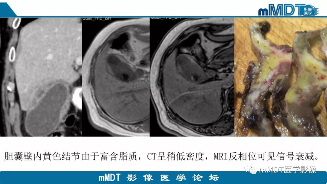 【PPT】黄色肉芽肿性胆囊炎与厚壁型胆囊癌的影像表现及鉴别要点