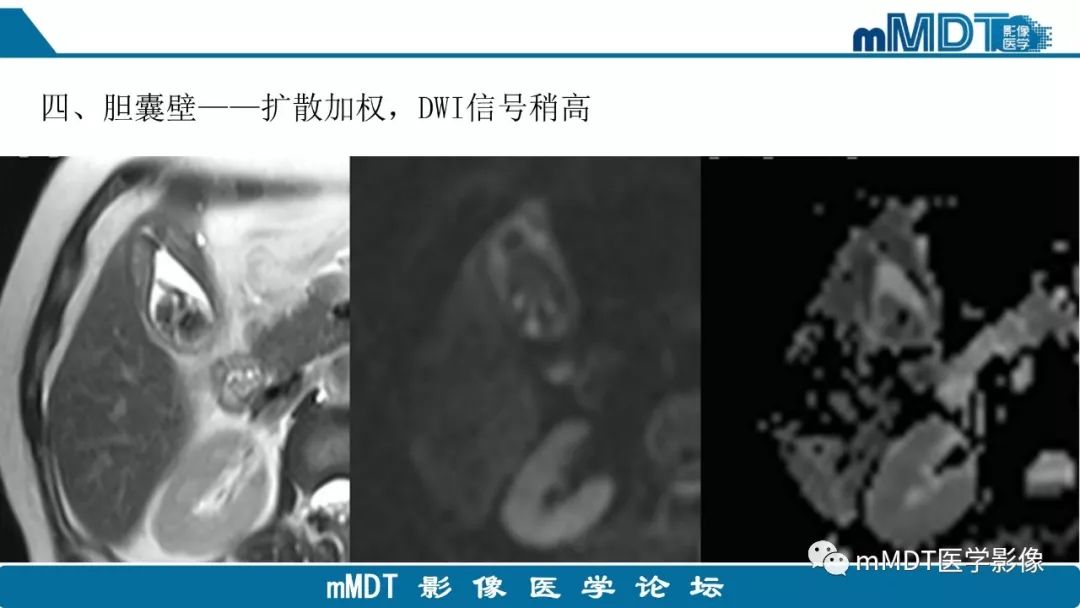 【PPT】黄色肉芽肿性胆囊炎与厚壁型胆囊癌的影像表现及鉴别要点