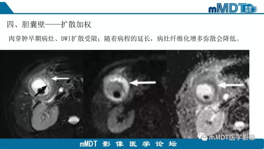 【PPT】黄色肉芽肿性胆囊炎与厚壁型胆囊癌的影像表现及鉴别要点