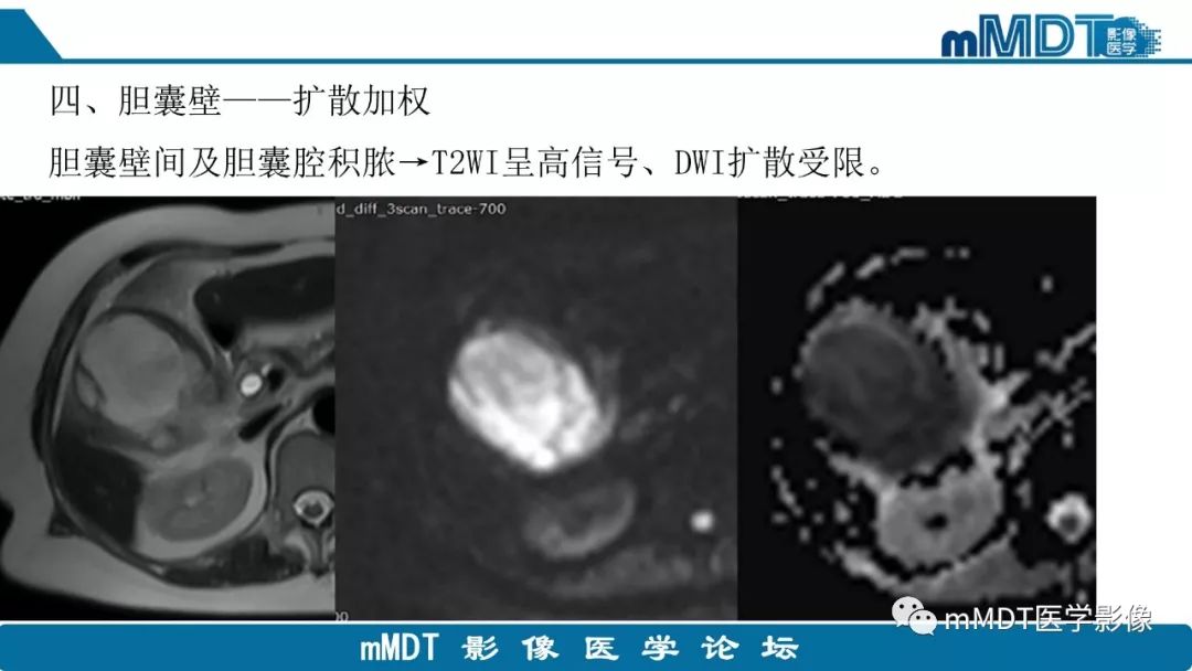 【PPT】黄色肉芽肿性胆囊炎与厚壁型胆囊癌的影像表现及鉴别要点