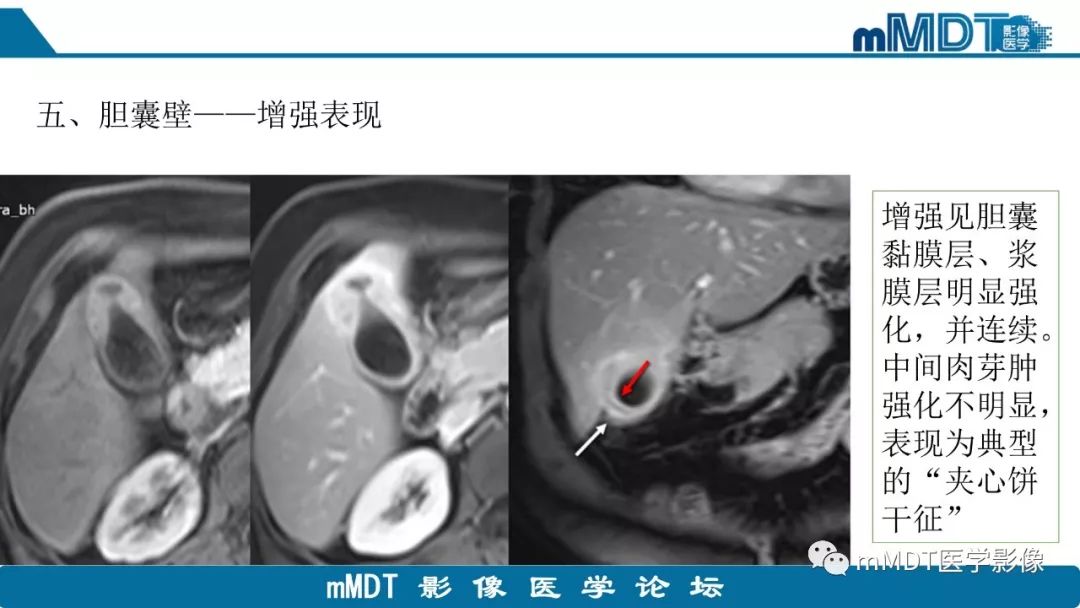 【PPT】黄色肉芽肿性胆囊炎与厚壁型胆囊癌的影像表现及鉴别要点