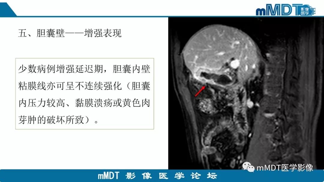 【PPT】黄色肉芽肿性胆囊炎与厚壁型胆囊癌的影像表现及鉴别要点