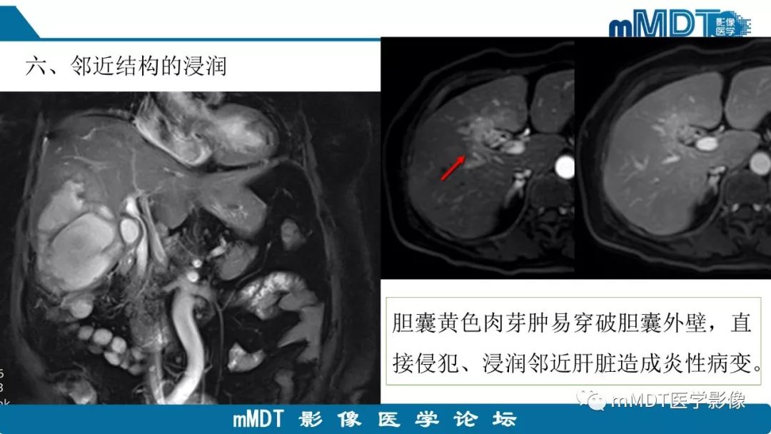 【PPT】黄色肉芽肿性胆囊炎与厚壁型胆囊癌的影像表现及鉴别要点