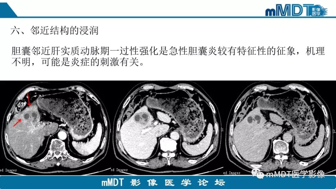 【PPT】黄色肉芽肿性胆囊炎与厚壁型胆囊癌的影像表现及鉴别要点