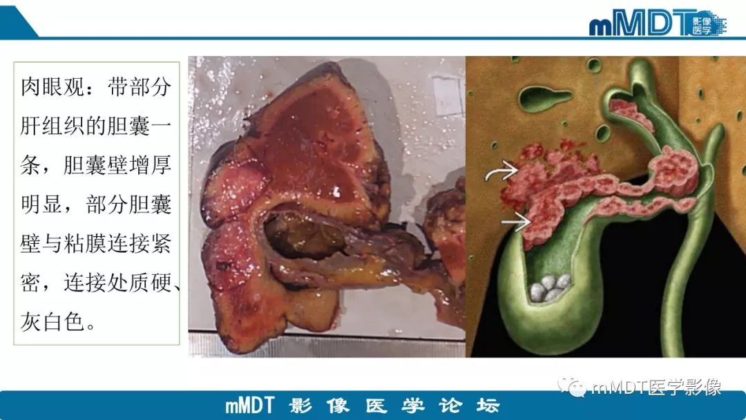【PPT】黄色肉芽肿性胆囊炎与厚壁型胆囊癌的影像表现及鉴别要点