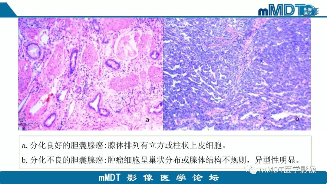 【PPT】黄色肉芽肿性胆囊炎与厚壁型胆囊癌的影像表现及鉴别要点