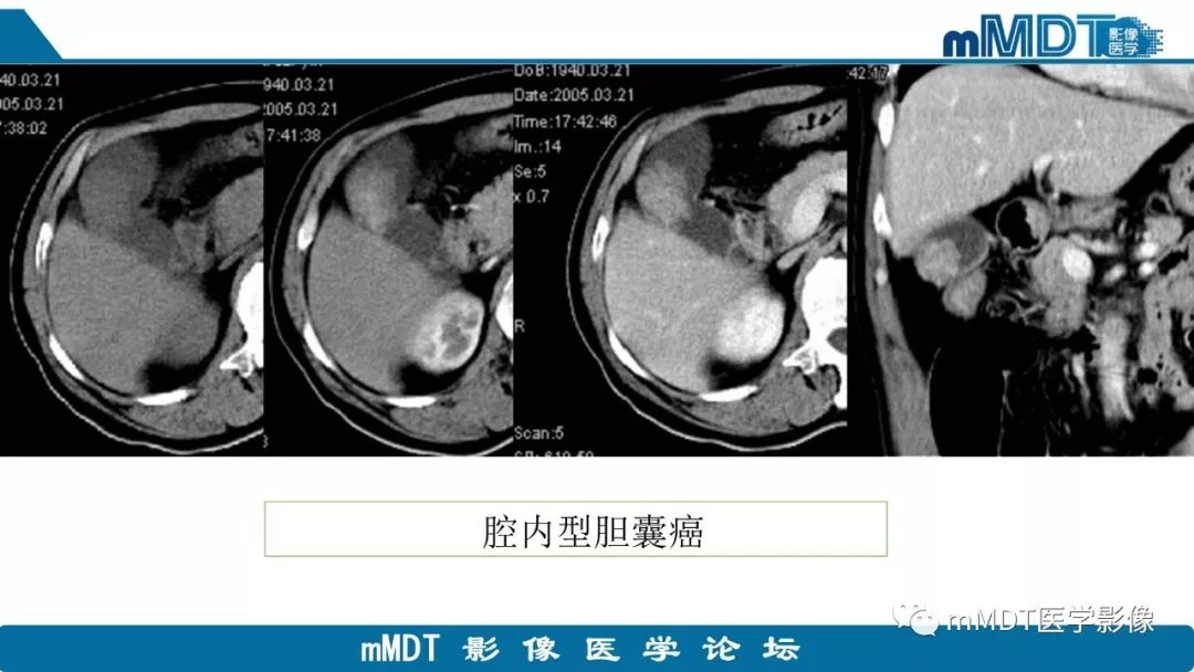 【PPT】黄色肉芽肿性胆囊炎与厚壁型胆囊癌的影像表现及鉴别要点