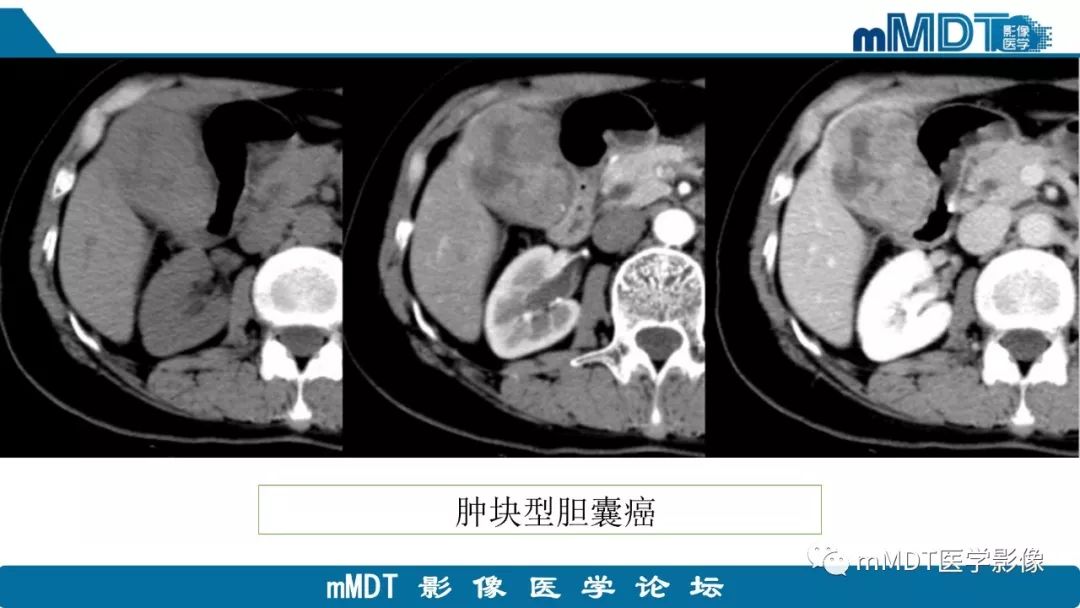 【PPT】黄色肉芽肿性胆囊炎与厚壁型胆囊癌的影像表现及鉴别要点