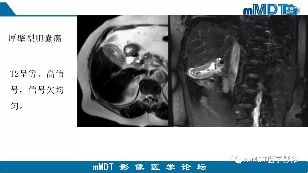 【PPT】黄色肉芽肿性胆囊炎与厚壁型胆囊癌的影像表现及鉴别要点