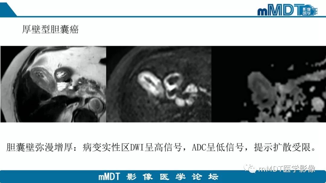 【PPT】黄色肉芽肿性胆囊炎与厚壁型胆囊癌的影像表现及鉴别要点