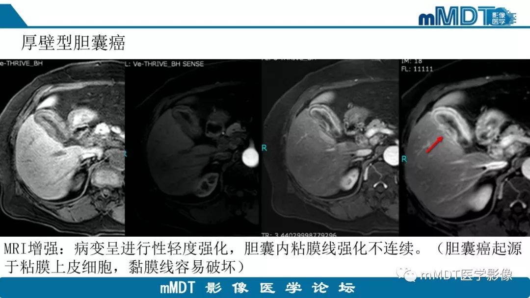 【PPT】黄色肉芽肿性胆囊炎与厚壁型胆囊癌的影像表现及鉴别要点