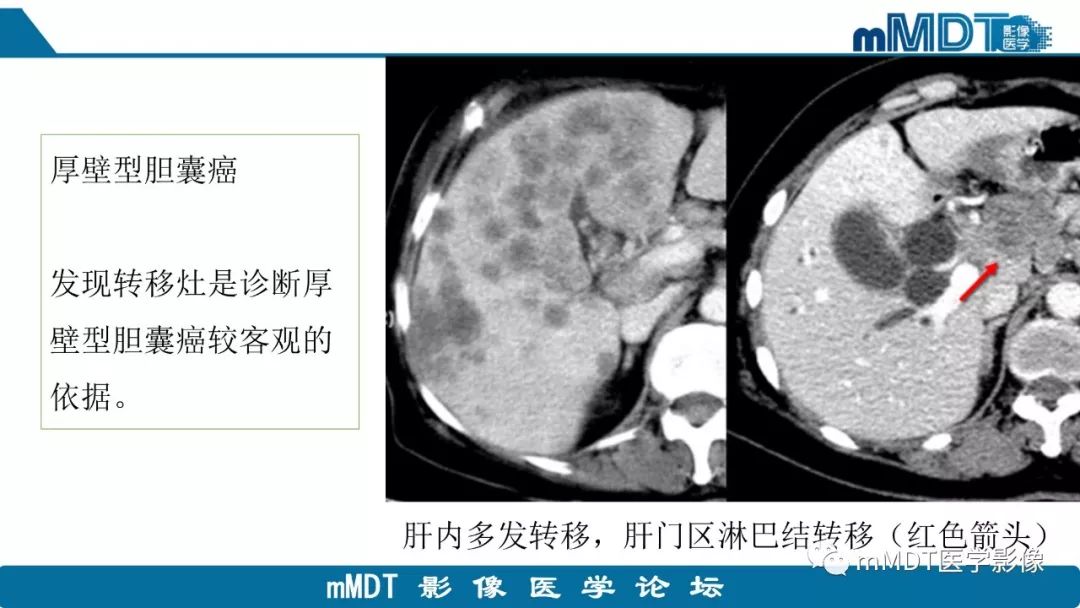 【PPT】黄色肉芽肿性胆囊炎与厚壁型胆囊癌的影像表现及鉴别要点