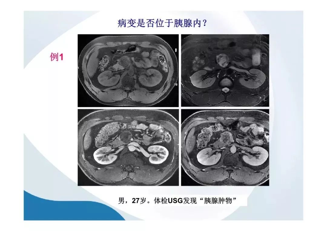 【PPT】胰腺非常见肿瘤影像学检查与诊断思路