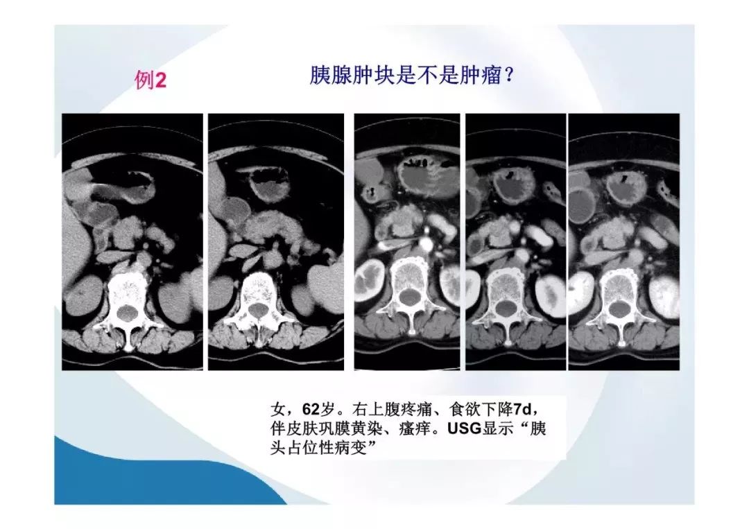 【PPT】胰腺非常见肿瘤影像学检查与诊断思路