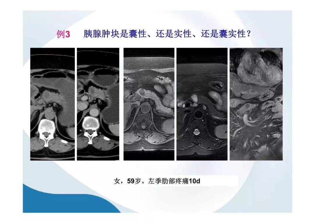 【PPT】胰腺非常见肿瘤影像学检查与诊断思路