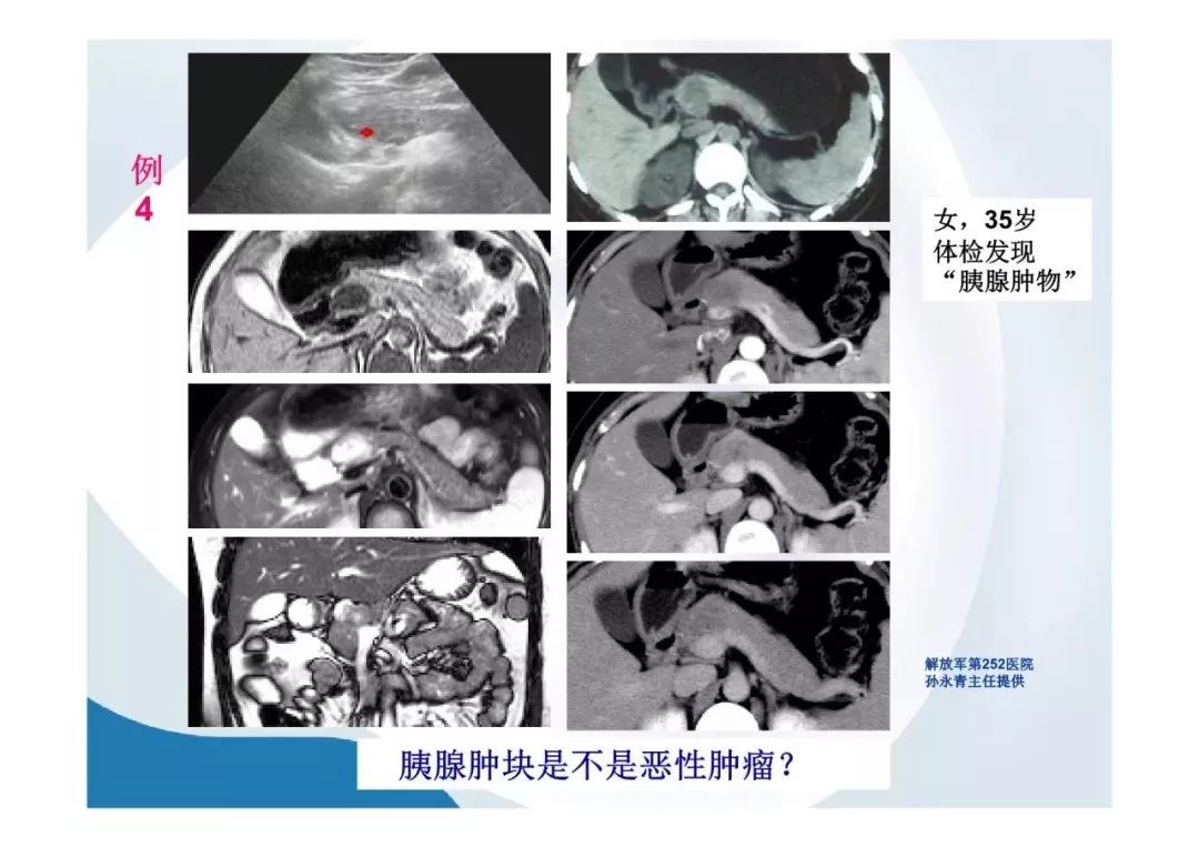 【PPT】胰腺非常见肿瘤影像学检查与诊断思路