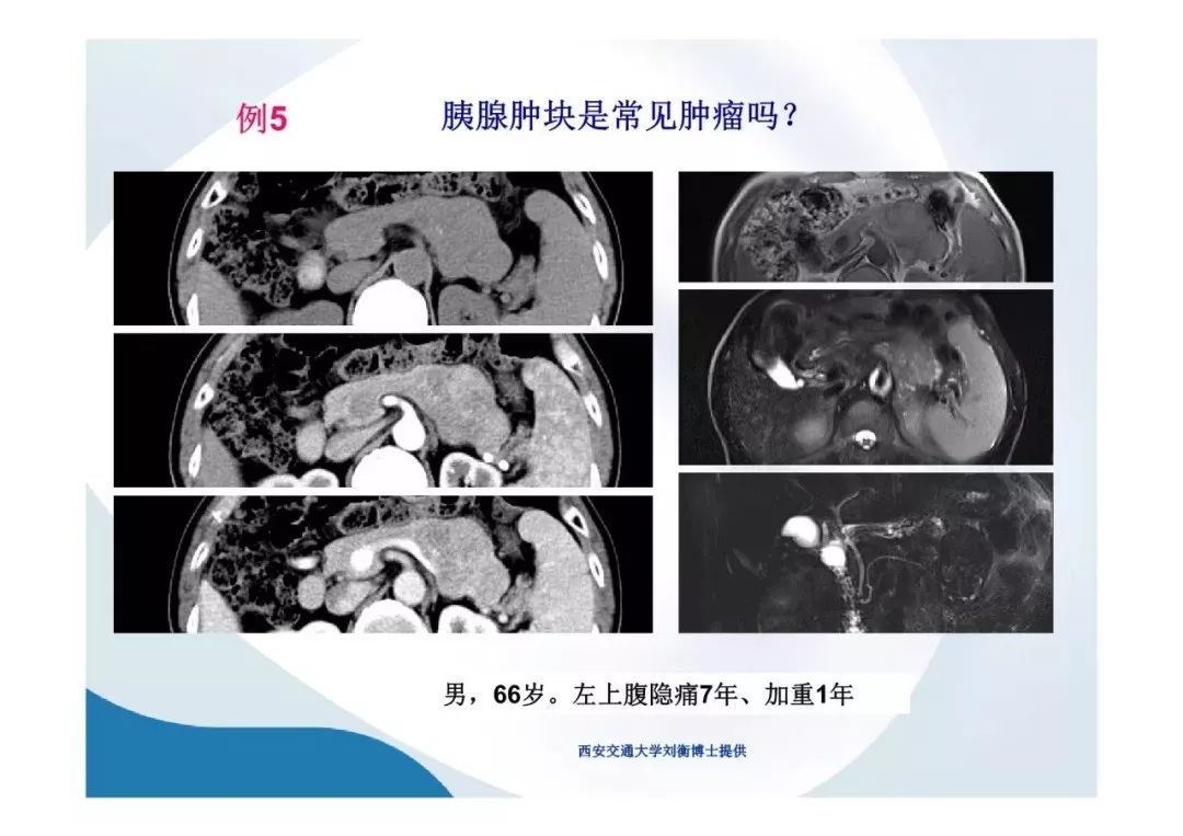 【PPT】胰腺非常见肿瘤影像学检查与诊断思路