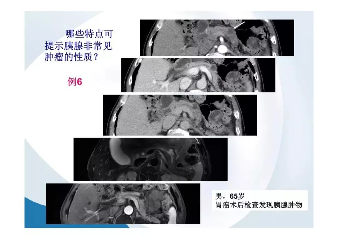 【PPT】胰腺非常见肿瘤影像学检查与诊断思路