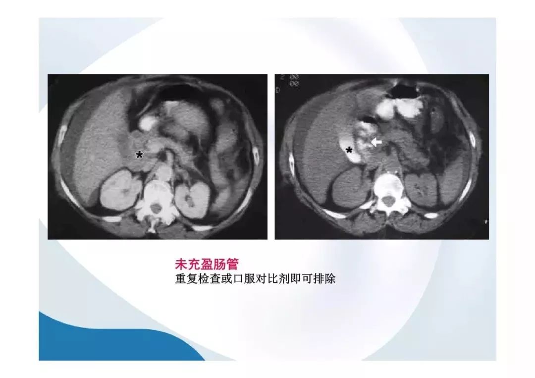 【PPT】胰腺非常见肿瘤影像学检查与诊断思路