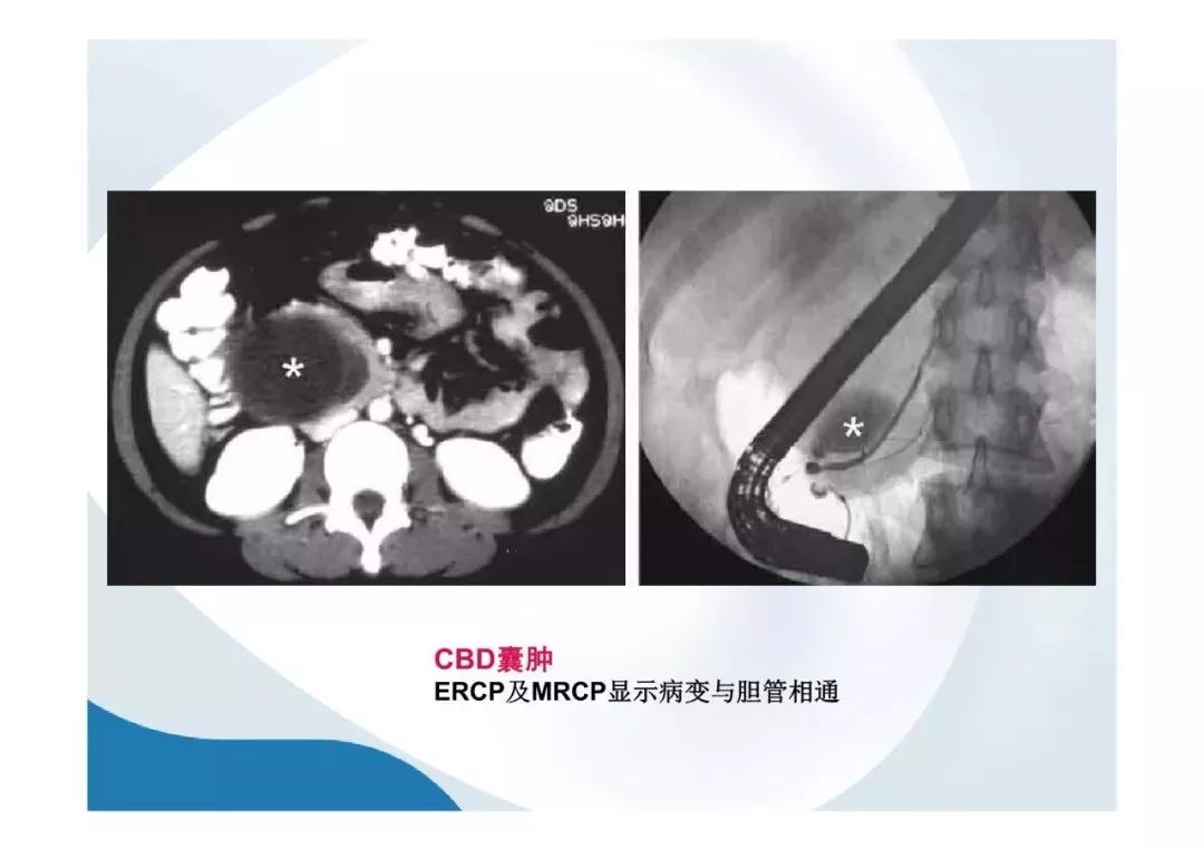 【PPT】胰腺非常见肿瘤影像学检查与诊断思路