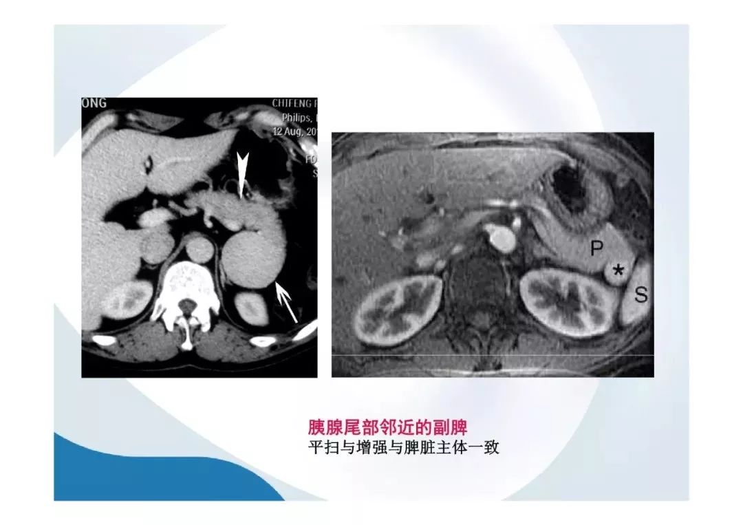 【PPT】胰腺非常见肿瘤影像学检查与诊断思路