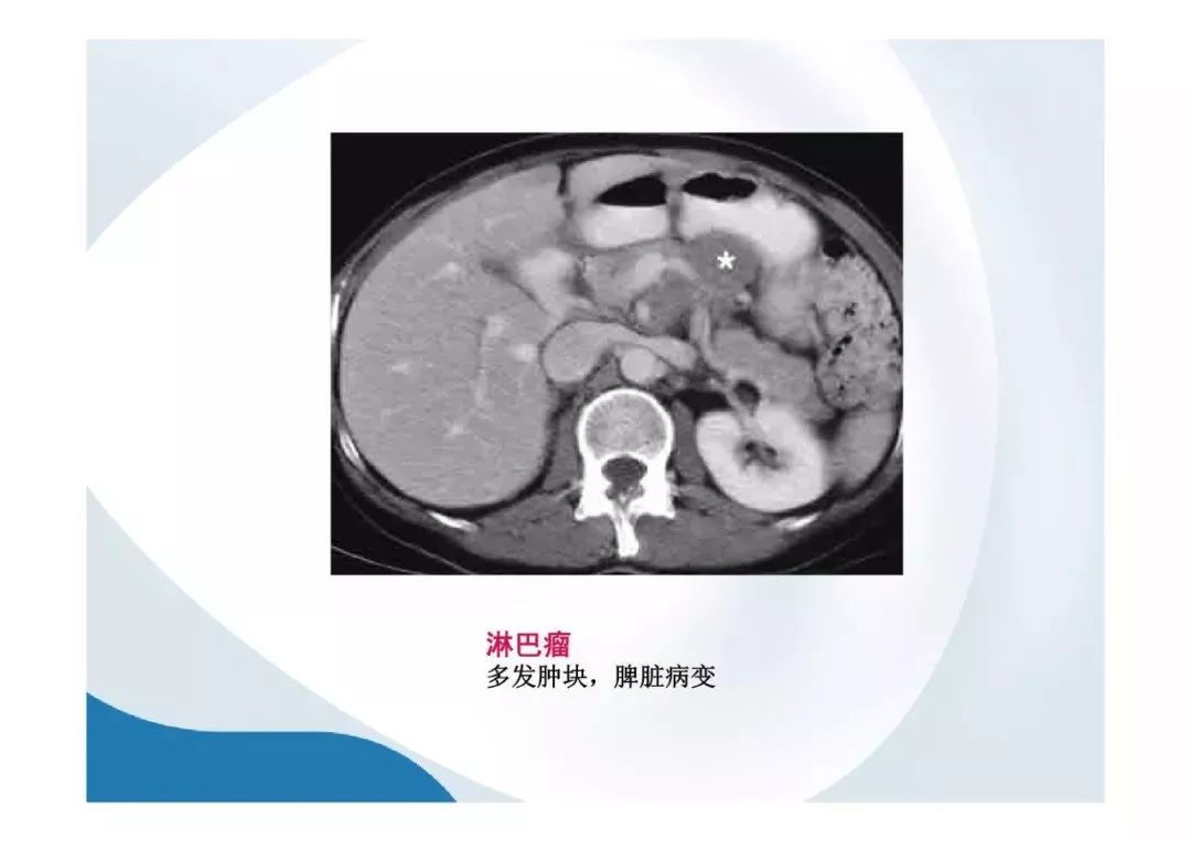 【PPT】胰腺非常见肿瘤影像学检查与诊断思路