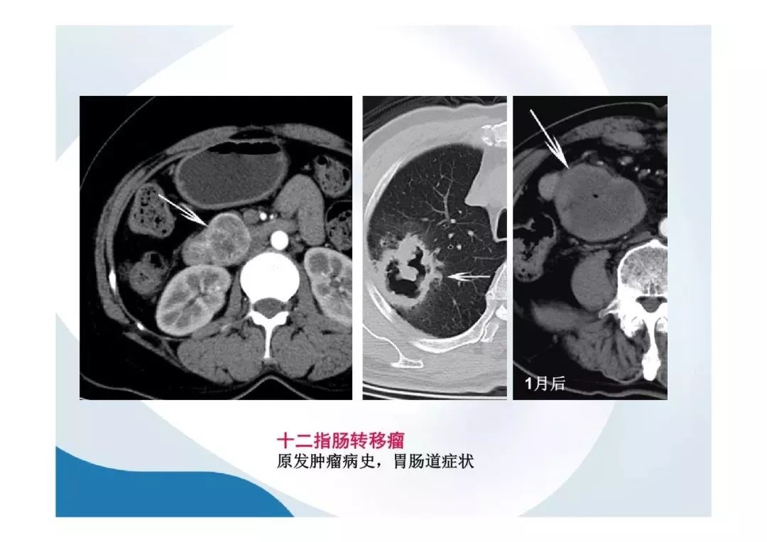 【PPT】胰腺非常见肿瘤影像学检查与诊断思路