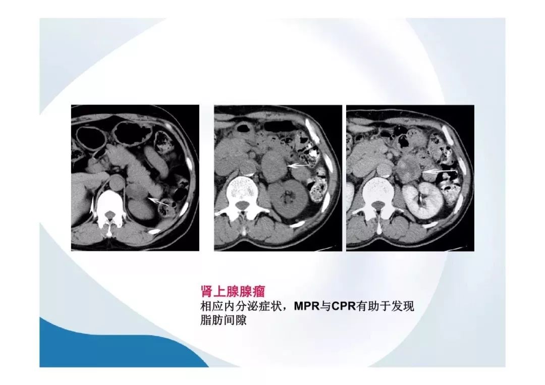 【PPT】胰腺非常见肿瘤影像学检查与诊断思路