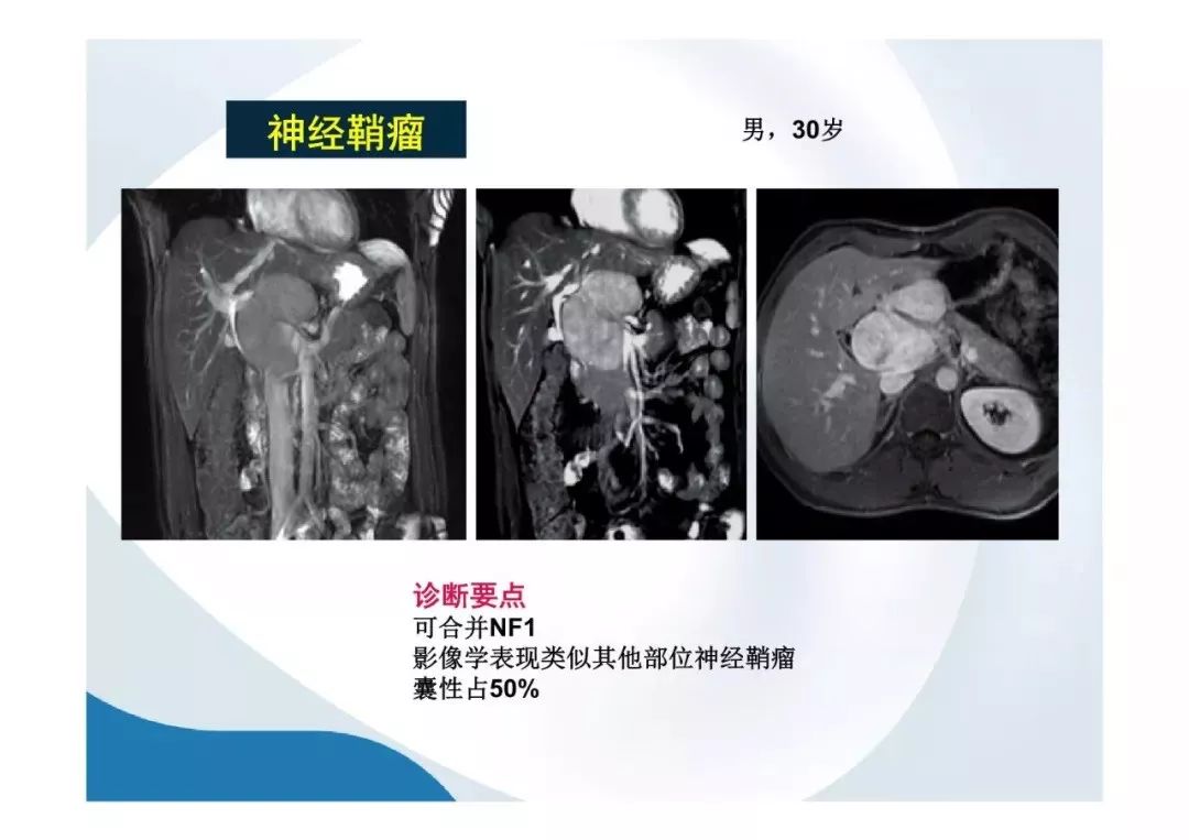 【PPT】胰腺非常见肿瘤影像学检查与诊断思路