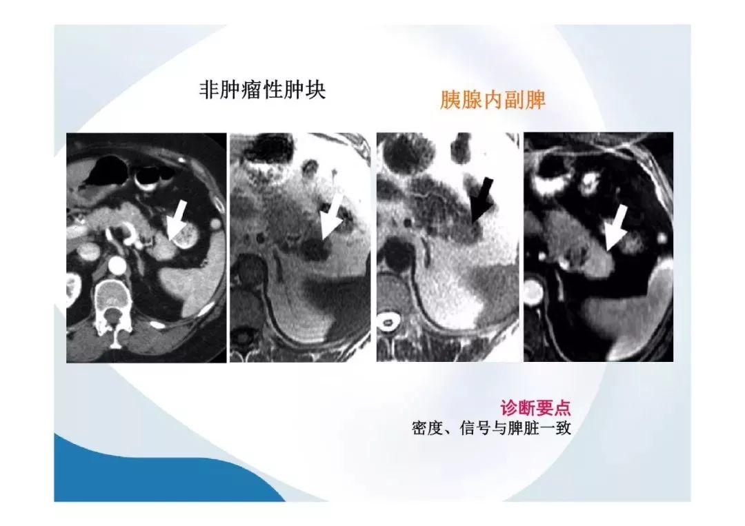 【PPT】胰腺非常见肿瘤影像学检查与诊断思路