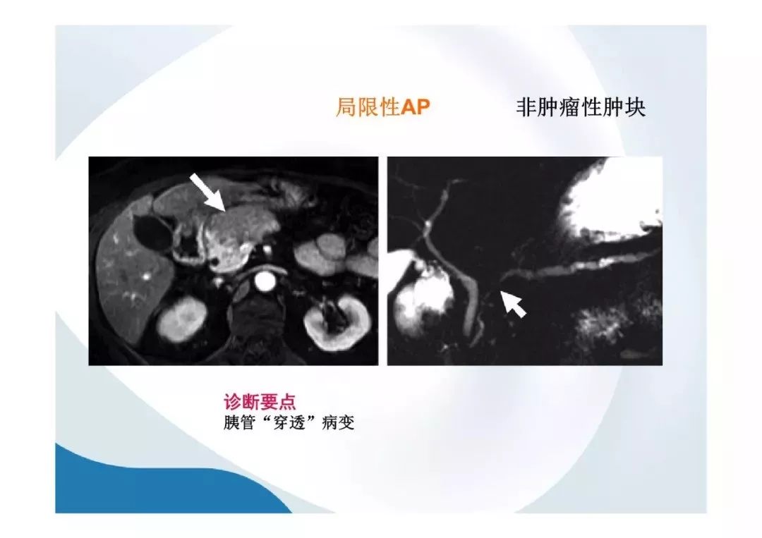 【PPT】胰腺非常见肿瘤影像学检查与诊断思路