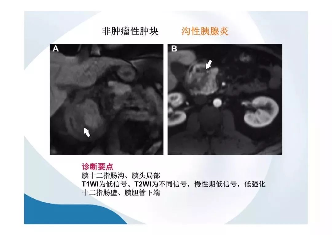 【PPT】胰腺非常见肿瘤影像学检查与诊断思路